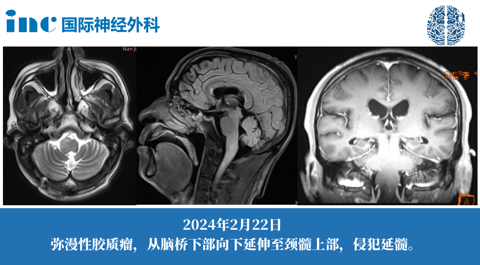 2024年2月22日 弥漫性胶质瘤，从脑桥下部向下延伸至颈髓上部，侵犯延髓。