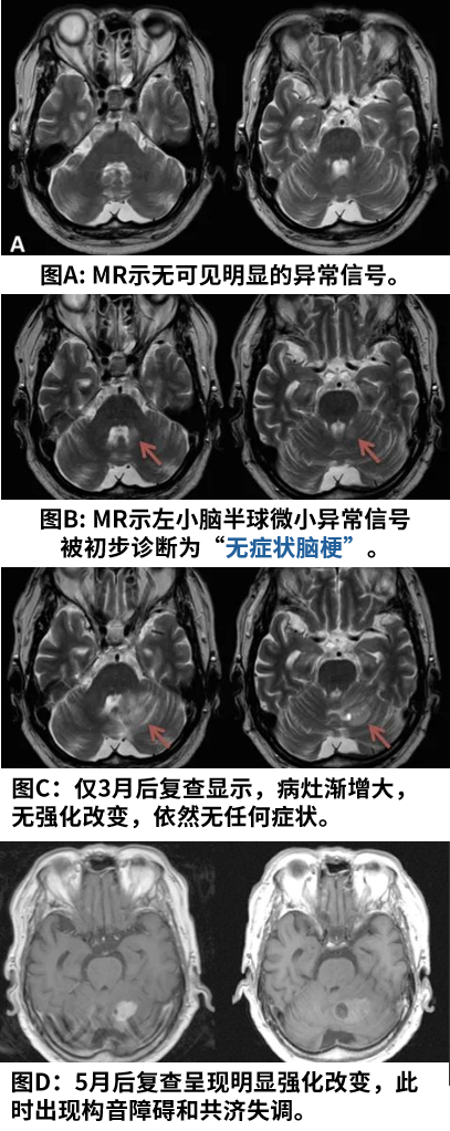 一位78岁脑梗患者的随访MRI，在左侧小脑半球意外捕捉到一个微小异常信号。