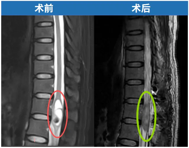 术前术后MRI对比