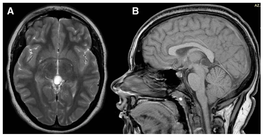 术前MRI，3年后复查，囊肿略增大（直径16 mm）