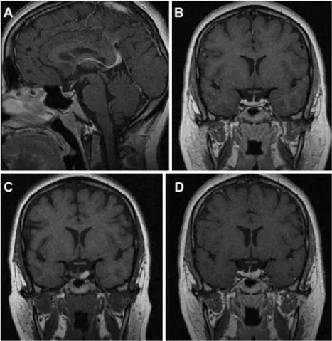 图1，一名27岁女性患者的磁共振成像（MRI）资料，该患者因垂体微腺瘤接受William T. Couldwell教授的随访监测，后续发生垂体卒中。