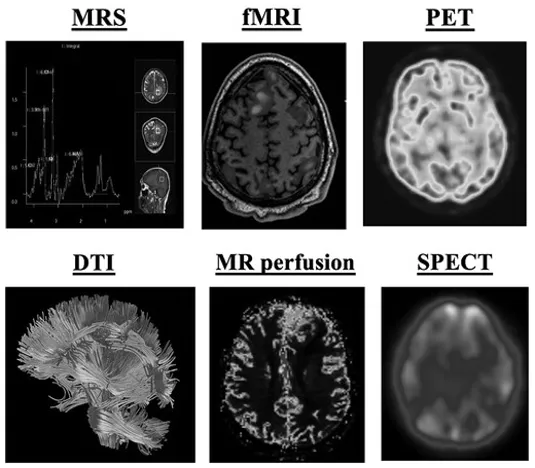 除了常见的CT、MRI，还有哪些先进以及新兴的技术能有帮助我们更好的了解胶质瘤呢？主要包括磁共振波谱成像（MRS）、灌注加权成像（灌注MRI）、弥散张量成像（DTI）、功能磁共振成像（fMRI）、正电子发射断层扫描（PET）、单光子发射计算机断层扫描（SPECT）以及其他新兴成像技术等。