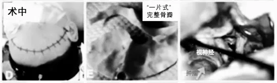 术中：成功全切