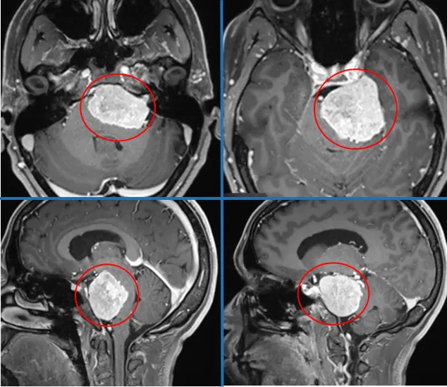 术前MRI