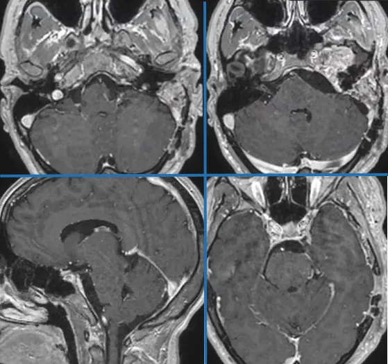 术后MRI