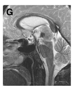 (G) 术后第 3 天MRI，造瘘处可见显著流空信号；ETV 后颅内压增高症状完全缓解。