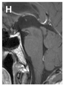 (H) 术后 2 年经幕下小脑上入路全切肿瘤后矢状位 T1 增强 MRI，示肿瘤全切除，患者无神经功能缺损，恢复良好。
