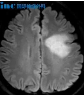 MRI 检查显示了位于左侧放射冠、半卵圆中心、胼胝体区的多发占位性病变，且肿瘤性病变的可能性较大
