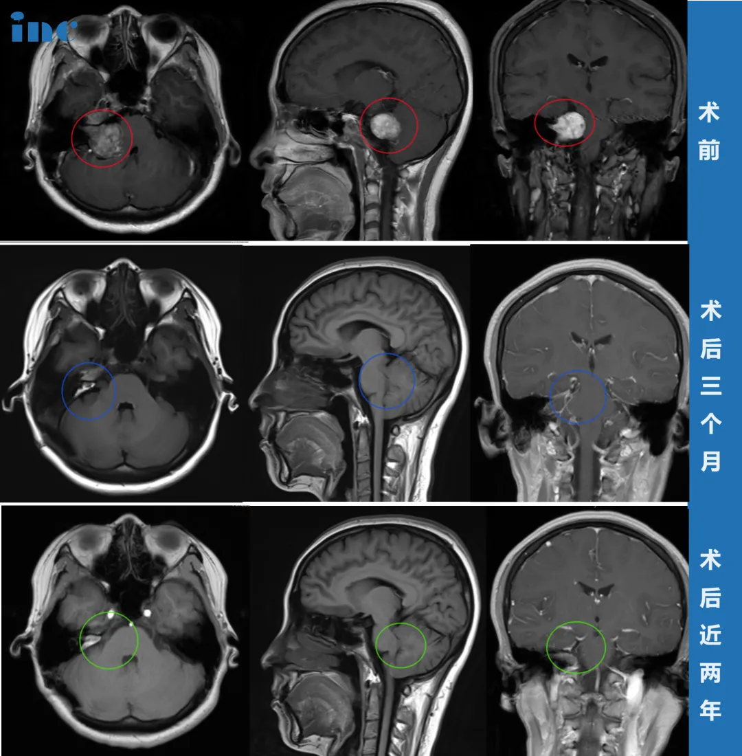术后当天，李女士就拔除了气管插管，能完全自主呼吸。复查 CT 显示正常，没有脑出血等并发症，随后转入普通病房康复。