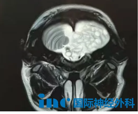 检查发现小脑脑干多发囊肿、脑积水