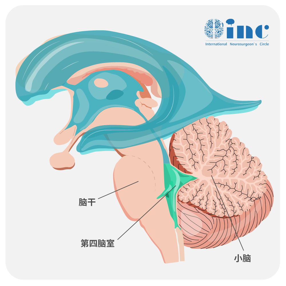 小脑缄默综合征（cerebellar mutism syndrome，CMS）