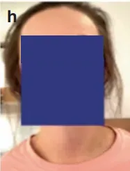 术后 MRI 清晰显示病灶消失,她不仅没出现新的神经功能缺损,并在术后第10 天就顺利出院!
