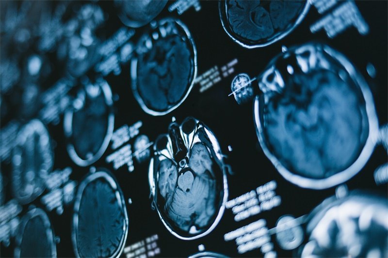 磁共振成像（MRI）的T1WI、T2WI怎么看？