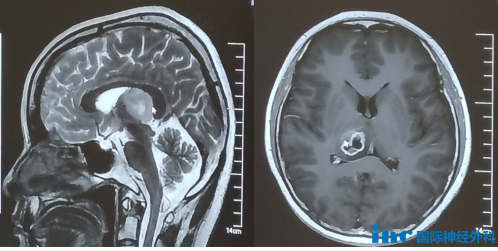 在苏州大学附属第四医院,巴教授还为一名26岁的丘脑占位女孩顺利手术,获得了满意的切除。