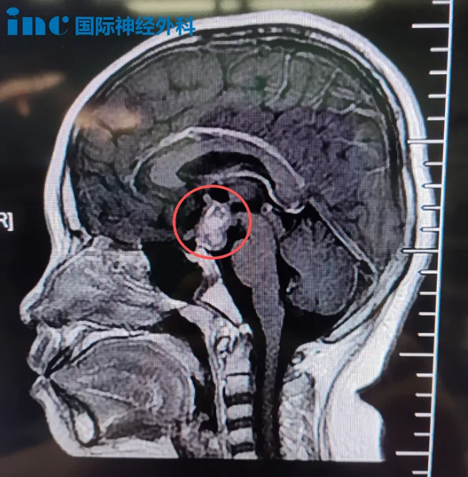 垂体柄被肿瘤撑成像气球一样,而手术要开一个小口,把“气球”里面的肿瘤取出来,外面这层薄薄的垂体柄还得想办法保留好。