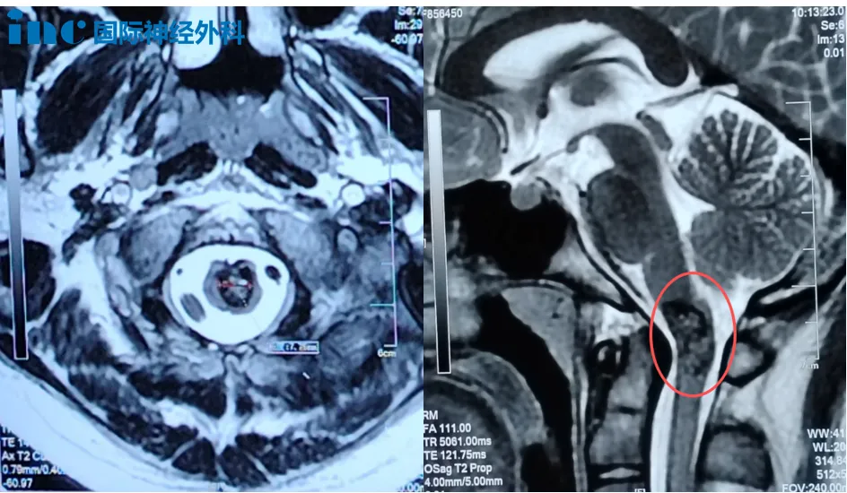 “延髓术后要切气管?还会瘫?” 面对面咨询巴教授怎么说?
