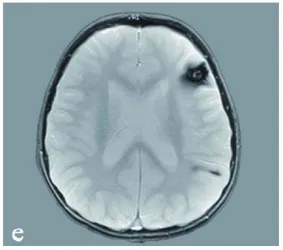 此外，还包括一个位于左额叶的致痫病灶（图1，e）。图e：显示患儿幕上其他海绵状血管瘤（左额叶及顶叶）