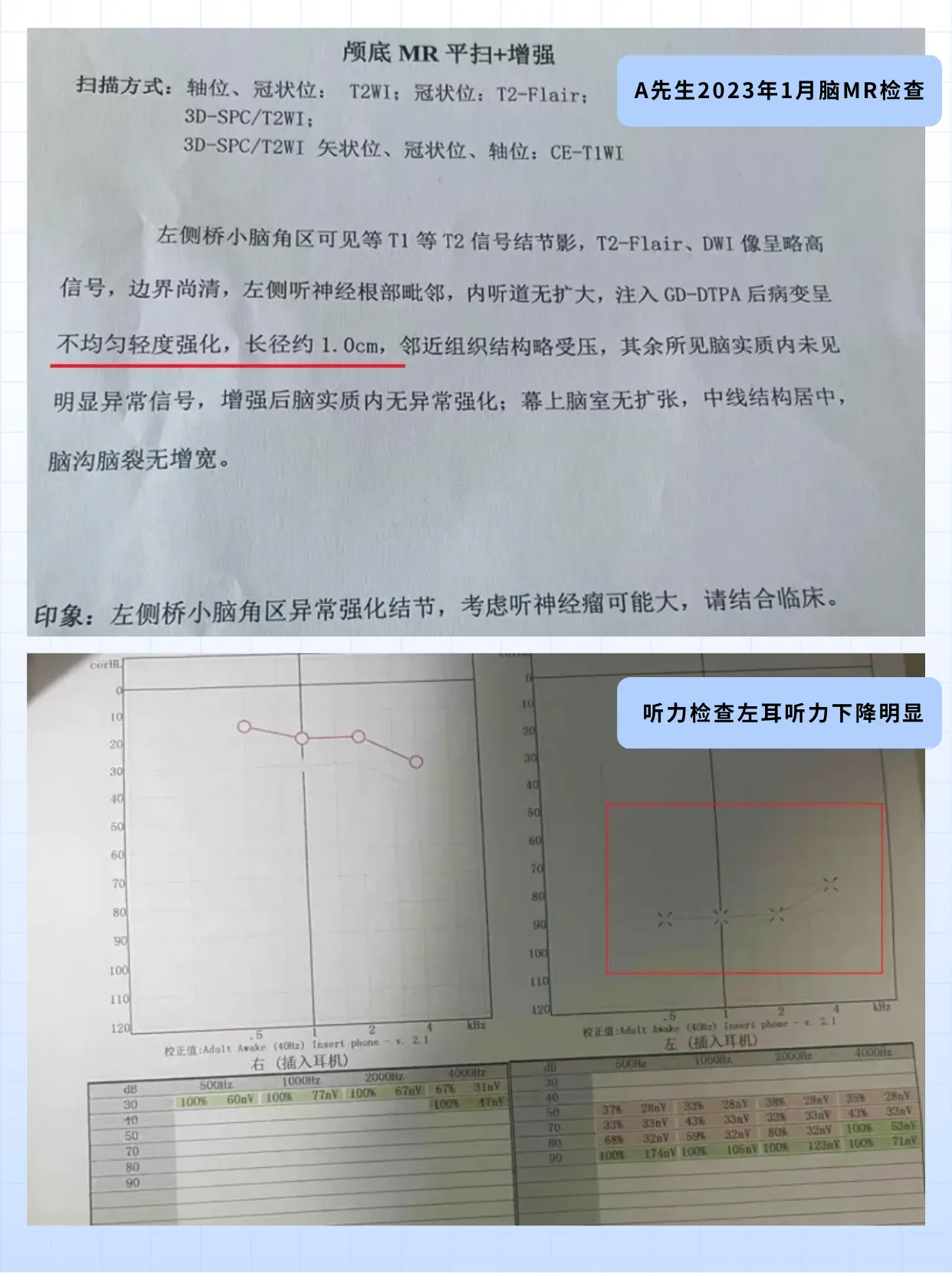 听神经瘤诊断难点分析