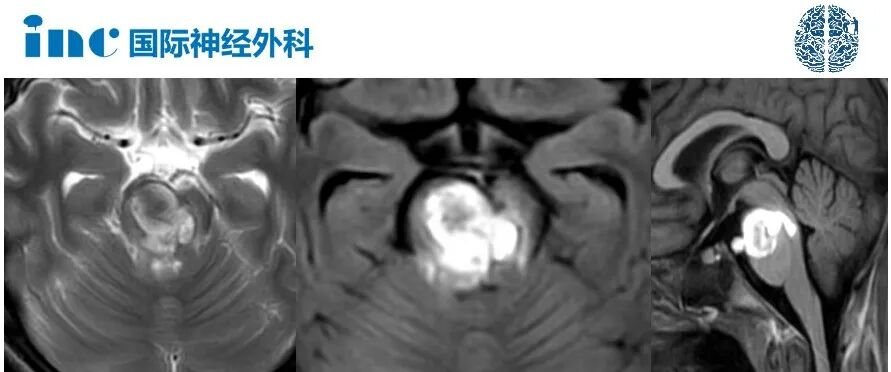 颅脑CT检查显示，孩子出现了严重的脑干海绵状血管瘤出血伴水肿。