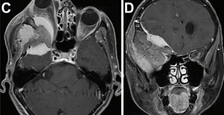 术前MRI(图C)显示显著的眼球突出及视神经受压程度(眼球突出指数=2.41)。肿瘤在蝶骨眶区浸润的显著宽度(图D)