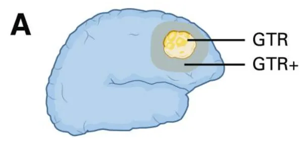 (A)大体全切除及超全切除示意图:展示GTR(大体全切除)、GTR+(超越影像学肿瘤边界的切除)与GTR–(切除范围≤100%)的界定标准。