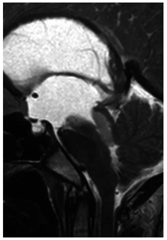 图2. 患者昏迷后急诊矢状位T2加权MRI，可见带蒂肿瘤深部移位至导水管内，造成完全性梗阻。