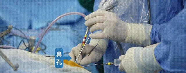 INC的福教授决定迎难而上,采用单鼻孔入路神经内镜手术。他使用多角度镜,配合“筷子技术”,仅通过一个8毫米的创口,成功切除了直径5厘米的肿瘤。