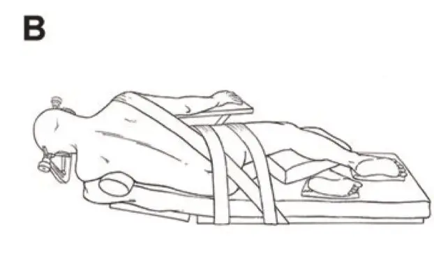 图B:病人采取侧卧位,应根据人体的四个生理弯曲及身体轴线,避免过度拉伸及屈曲,同时尽可能缓解压力集中的压迫点压力。