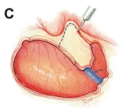 图C:切除在颞枕区域至枕下区域延伸的L形骨瓣后,沿着乳突周围外层开始逐步完成乳突切除术。骨瓣大小取决于听力状况和基础暴露的需要。