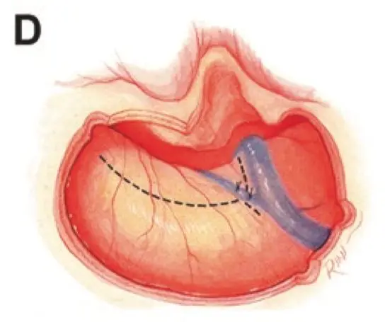 图D:硬脑膜切口设计