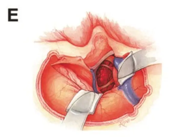 图E: 打开硬膜,避免损伤横-乙状窦及Labbé静脉,该区域后颞叶的静脉引流存在变化(有时是多种多样的),结扎上岩窦后,并确保颞叶的引流通畅,沿着岩骨尖分离天幕,定位并注意保护滑车神经等。