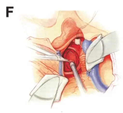 图F:在分离、暴露、切除肿瘤过程中,注意保留所有颅神经及重要血管。