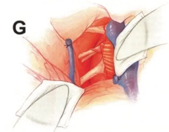 图G:肿瘤成功全切,神经组织保存完好。