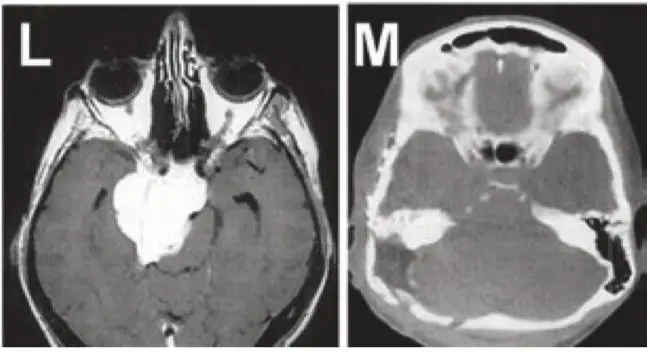 图L+M:岩斜区脑膜瘤患者,术前术后的影像对比