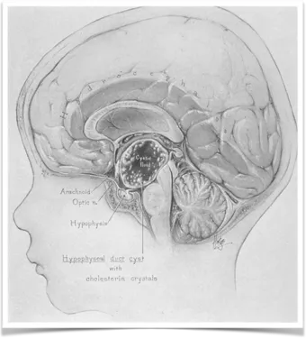 WALTER E. DANDY在《SURGERY OF THE BRAIN》一书中对颅咽管瘤的图示