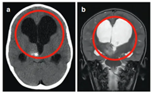一个从无手术指征到有手术指征的丘脑病变