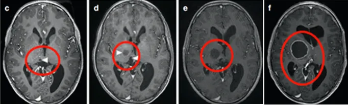 肿瘤一直长大,而且长出了很多小的囊肿。同侧内囊(负责人体肢体运动)也向前外侧移位,导致马修从左上肢震颤到急性偏瘫。
