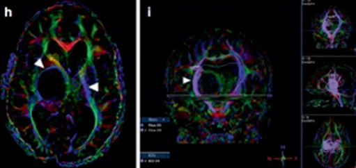 为了治疗多发囊肿,他们找到INC鲁特卡教授植入ommaya囊并在超声引导下将导管插入肿瘤囊性成分。MRI显示囊性占位解除,脑室慢慢恢复正常。