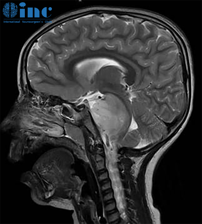 并不是所有的胶质瘤都有手术机会,比如DIPG。