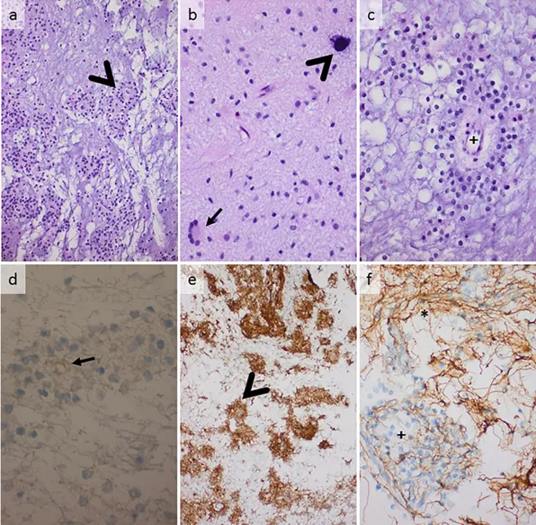 肿瘤组织学显微照片