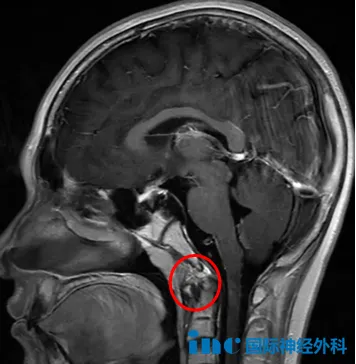 颅底斜坡区一个33×26×33mm的大肿瘤,已经侵袭左侧海绵窦,导致垂体移位,就连垂体柄都已被推歪。医生高度怀疑这是一个脊索瘤。