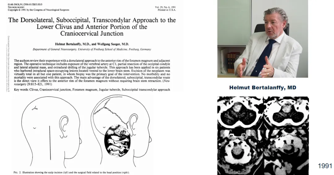 早期颅底入路常用于治疗血管病变,随着影像学技术和手术器械的进步,颅底外科手术逐渐变得更加精确和安全。