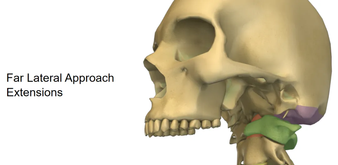 远外侧入路的扩展应用与稳定性考量