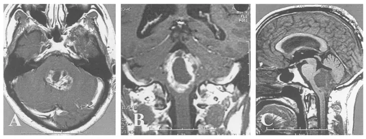 延髓区域发现一个大型囊实性室管膜瘤，它像藤蔓一样，向上爬入第四脑室，向下钻进了椎管