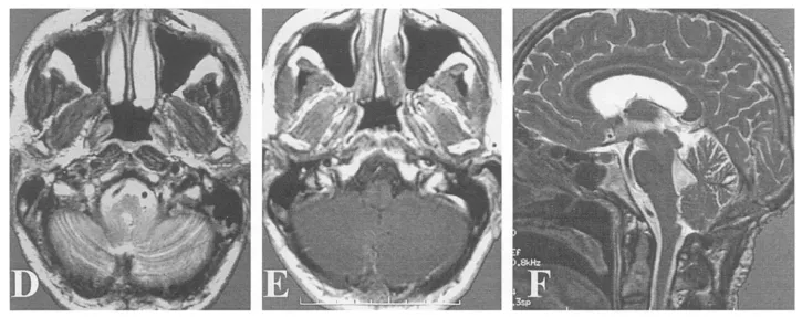 （D-F）术后6个月MR证实肿瘤全切。