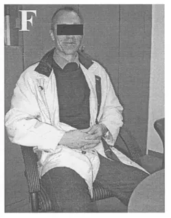 （F）术后6个月患者临床状态良好。