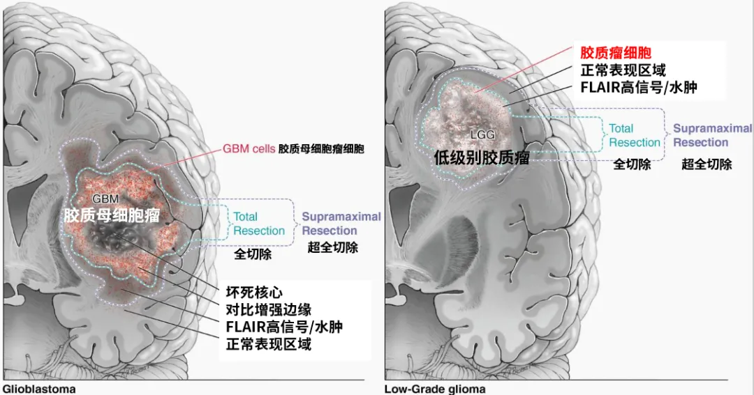 图2. 图示高级别(a)和低级别(b)胶质瘤的超全切除定义。