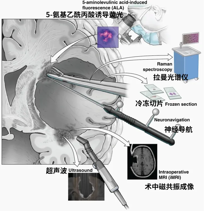 图4. 术中识别肿瘤边缘的方法。