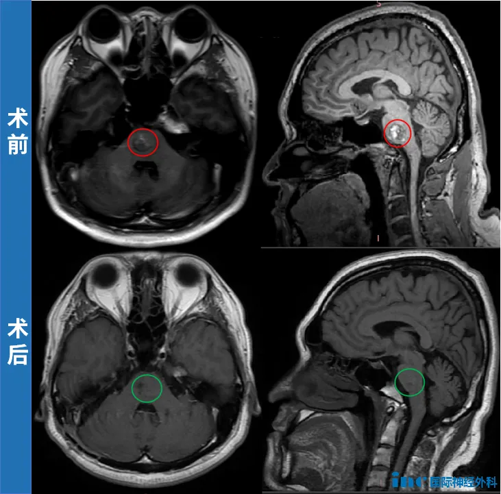 39岁的杜先生，一位曾与脑干（桥脑）海绵状血管瘤顽强抗争的勇士。作为中外学术交流的受益者，而接连三个“没想到”的转折，却彻底扭转了他的命运——没想到这病能手术，没想到急需手术，更没想到术后这么好！