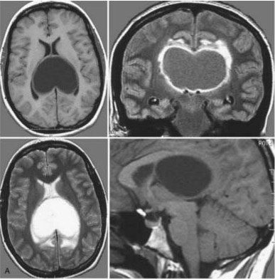 磁共振成像(MRI)在轴位(左上、左下)、冠状位(右上)和矢状位(右下)显示一个大型囊性肿瘤,占据双侧侧脑室后部。